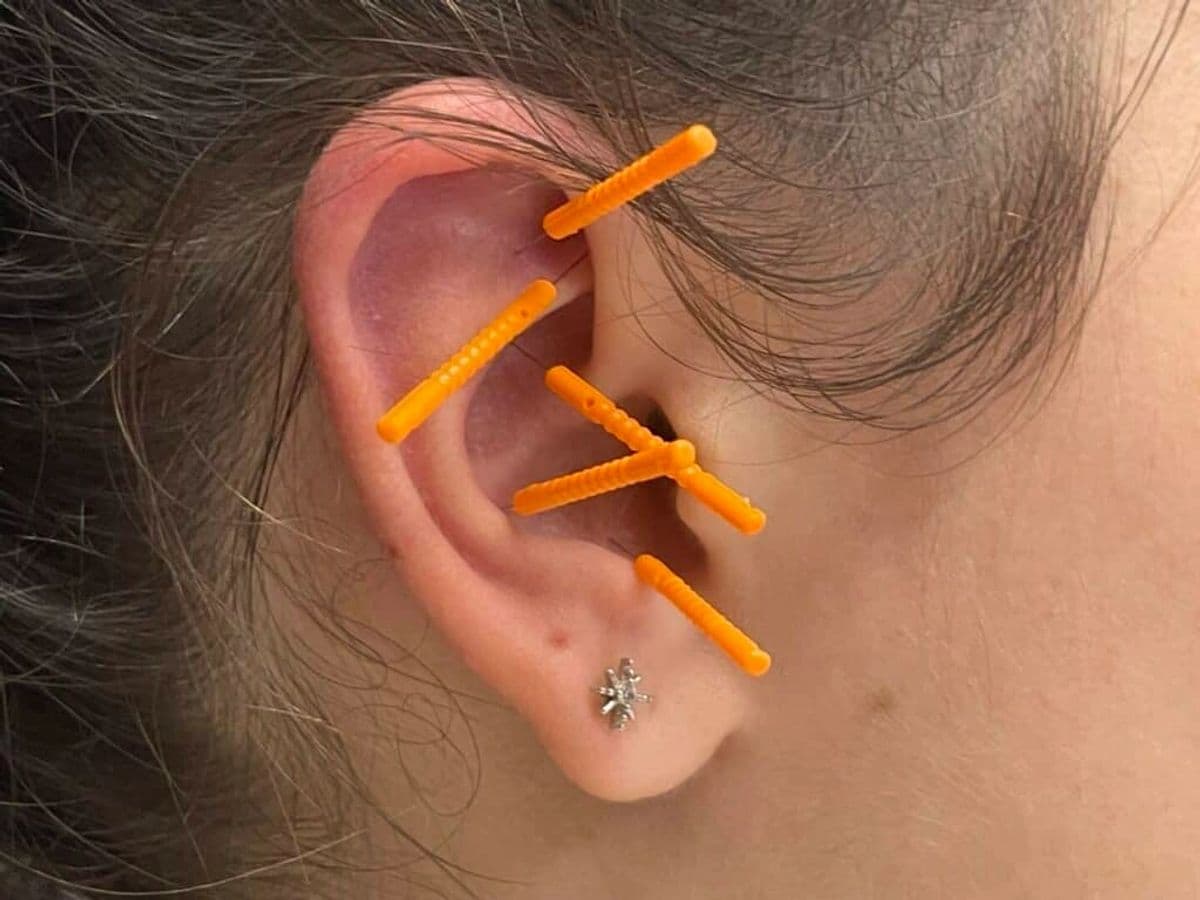 Ear acupuncture in Sugar Land, Texas